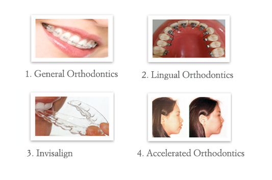 1.General Orthodontics 2.Lingual Orthodontics 3.Invisalign 4.Accelerated Orthodontics 