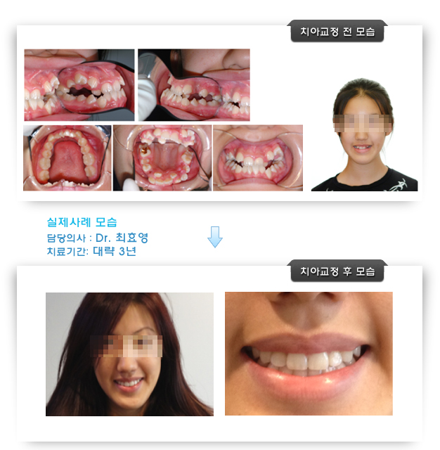 최효영 치과 교정 실제사례 모습